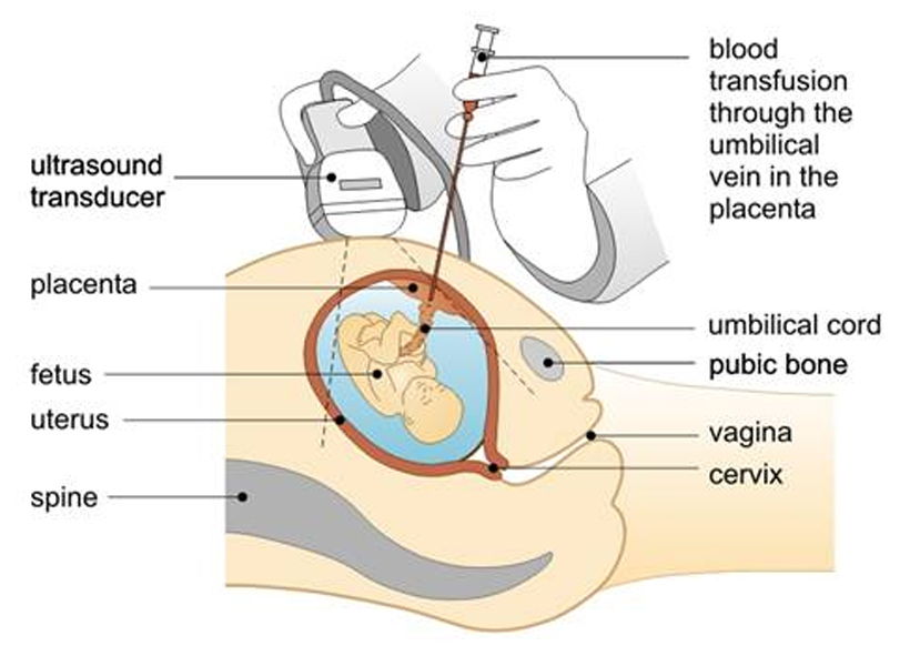 Intrauterine Transfusion